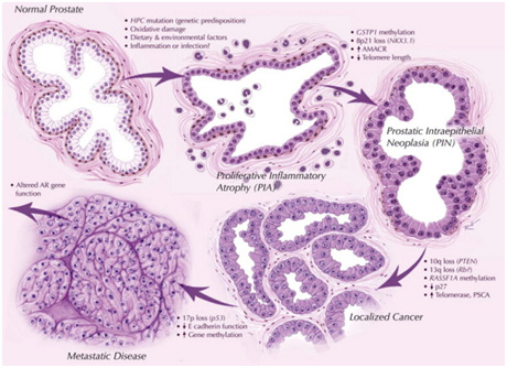 Prostat Kanserinde Etyoloji ve Moleküler Genetik