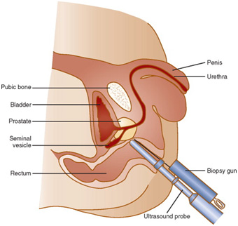 Prostat biyopsi teknikleri