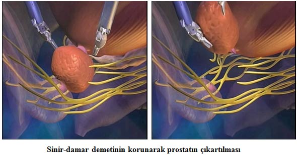 Sinir damar demetinin korunarak prostatın çıkarılması